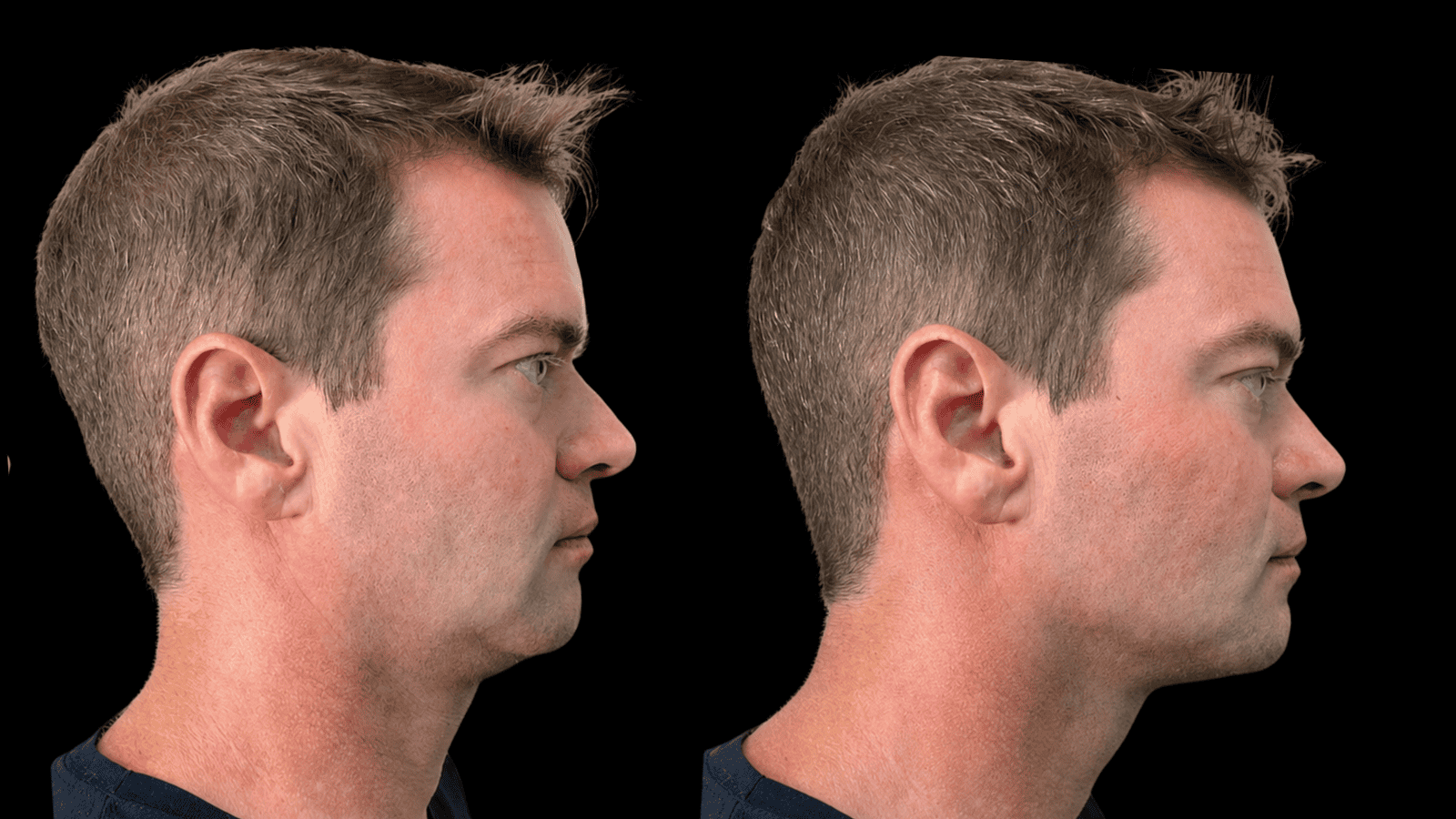 Antes e depois - Protocolo Evolution