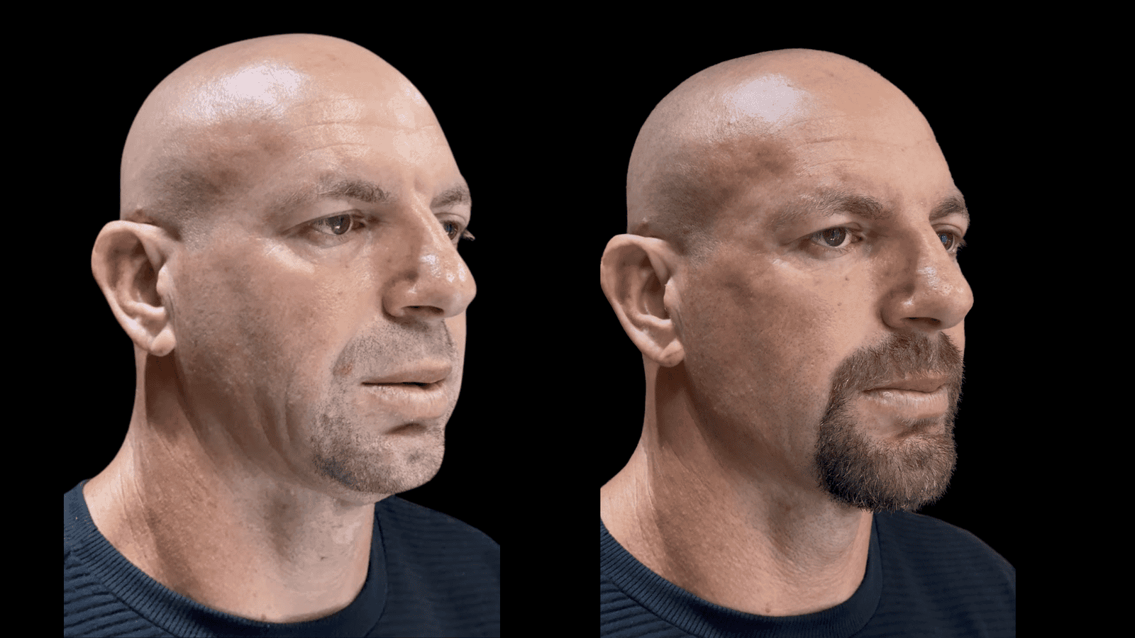 Antes e depois - Exojet + Bioform