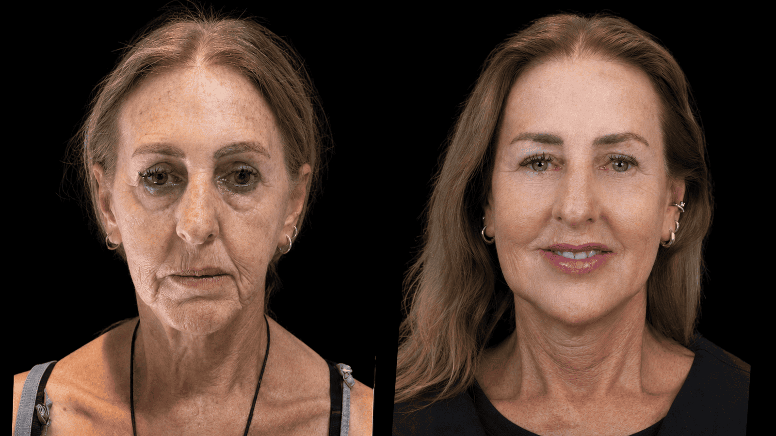 Antes e depois