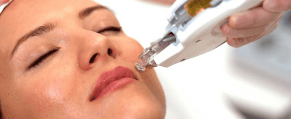 Exojet, protocolo de mesoterapia facial sem agulha por eletroporação com exossomos, PDRN e GHK-Cu, em clínica de estética de alto padrão em Florianópolis
